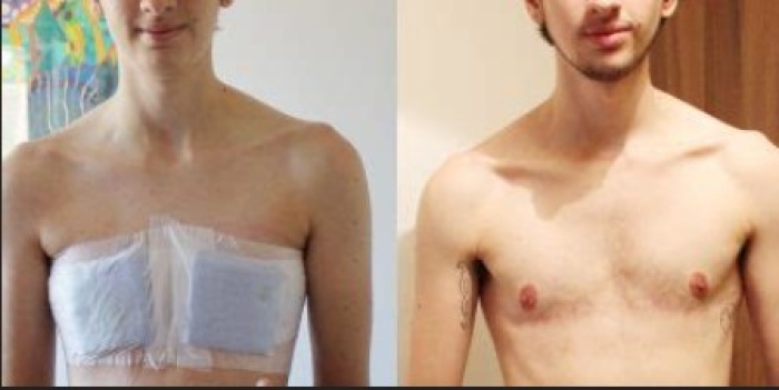 A transgender male (biological female) who had her breasts surgically removed to appear like a male.  (Screenshot)  