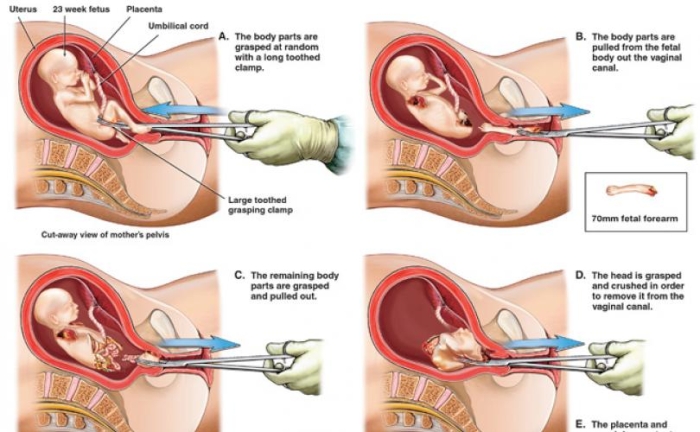 Illustration of a D and E abortion, dilation and evacuation. (Screenshot)